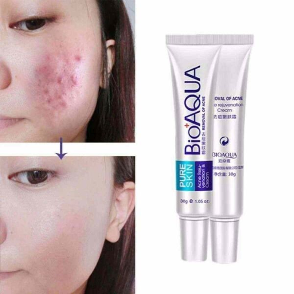 Bioaqua Skin Care Acne Treatment Remove Pimples Face Acne Scars