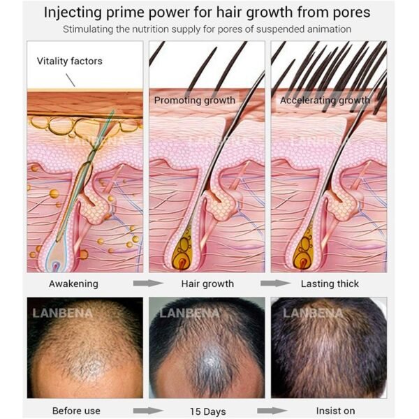 LANBENA HAIR GROWTH ESSENCE SPRAY PRODUCT PREVENTING BALDNESS CONSOLIDATING ANTI HAIR LOSS NOURISH ROOTS EASY TO CARRY HAIR CARE